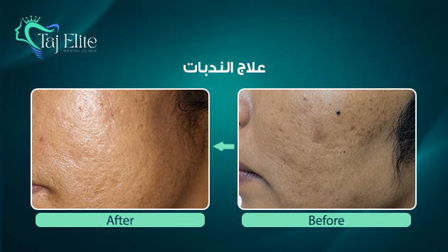 before-^-after9